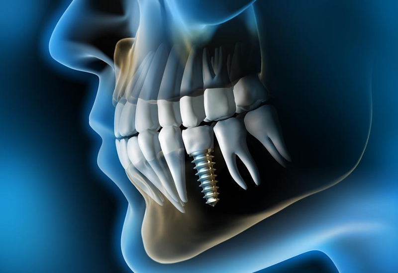 Implantes dentales Marbella