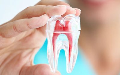 ¿Qué es la endodoncia y cuáles son sus pasos?