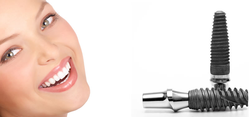 Implantes Dentales en SpecialDent Marbella: Transformando Sonrisas