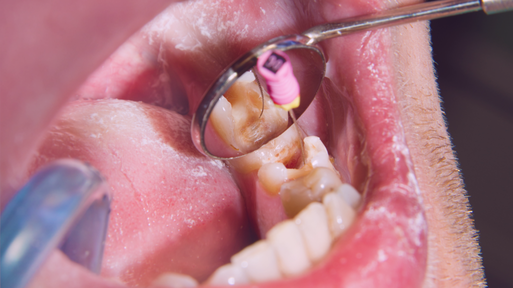 endodoncia dental