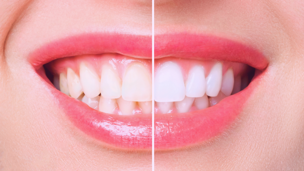 blanqueamiento dental