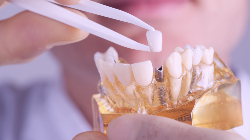 implante dental