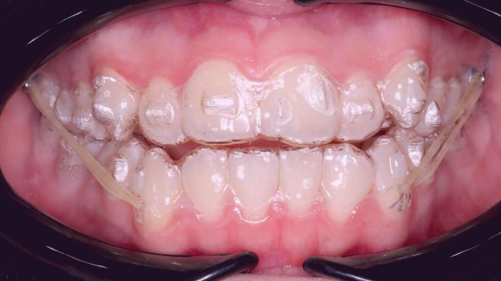 invisalign